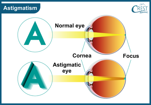 Causes of Astigmatism: - CREST OLympiads