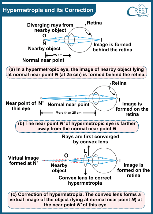 Hyper Metropia and its Correction - CREST Olympiads