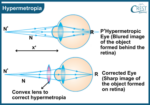 Labelled Diagram of Hypermetropia - Science Grade 8