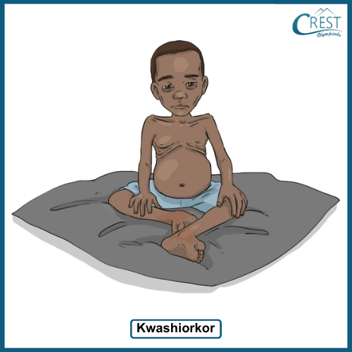 Symptoms of Kwashiorkor - Science Grade 6