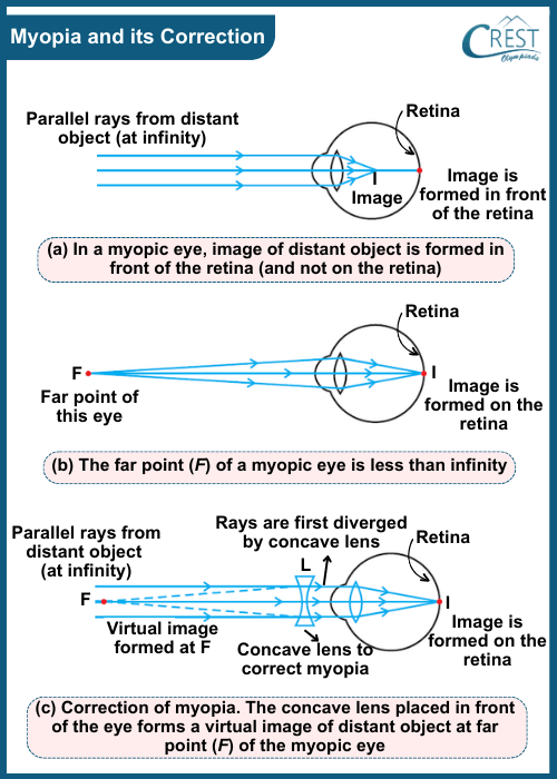 Myopia and Its Correction - CREST Olympiads