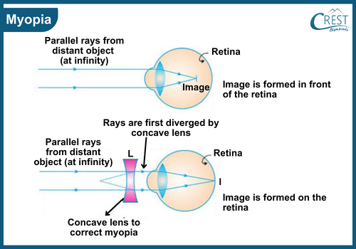 Labelled Diagram of Myopia or Nearsightedness - Science Grade 8