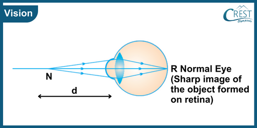 Defects of Vision or Refractive Errors- Science Grade 8